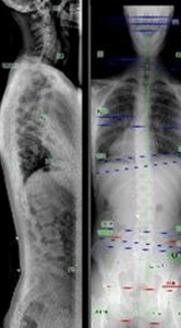 Chiropractic Oshkosh WI X-Ray